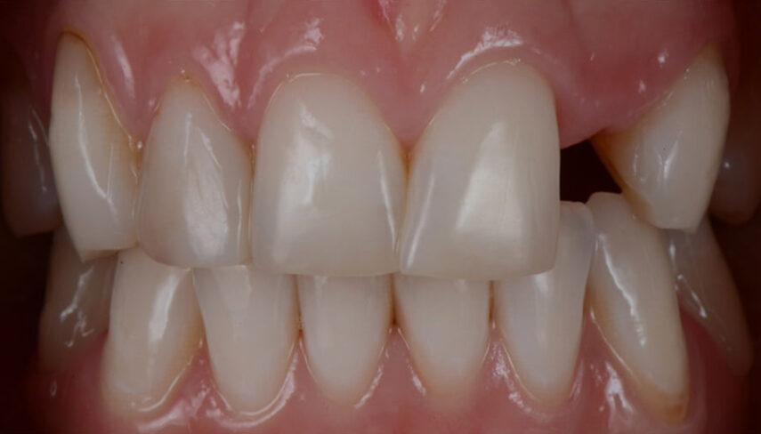 Before - Implants By Chani 
